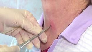 Два случая заражения боррелиозом зарегистрировали в Первоуральске